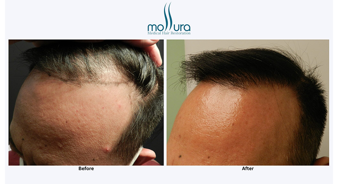 2 Session Norwood Hair Loss Class 3 FUT Hair Transplant &ndash; before and after
