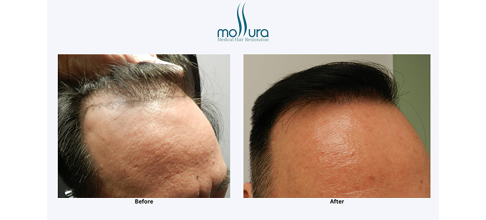 2 Session Norwood Hair Loss Class 3 FUT Hair Transplant &ndash; before and after