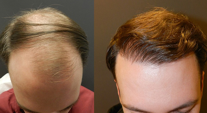 2,200 Hair Graft Hair Transplant Case Study &ndash; Norwood Class 5 &ndash; before and after