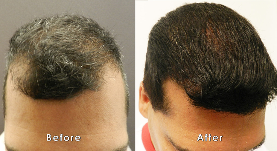 FUE Hair Transplant To Fill Temporal Hairline &ndash; before and after