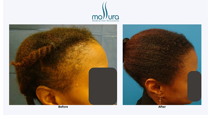 Hair Restored Along the Edges from Traction Alopecia &ndash; before and after