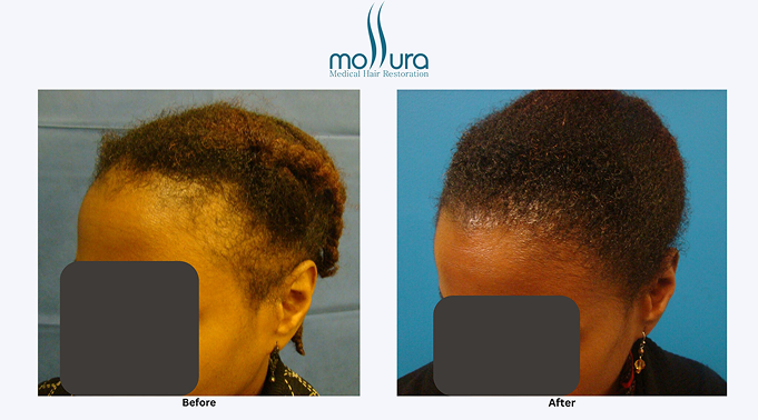 Hair Restored Along the Edges from Traction Alopecia &ndash; before and after