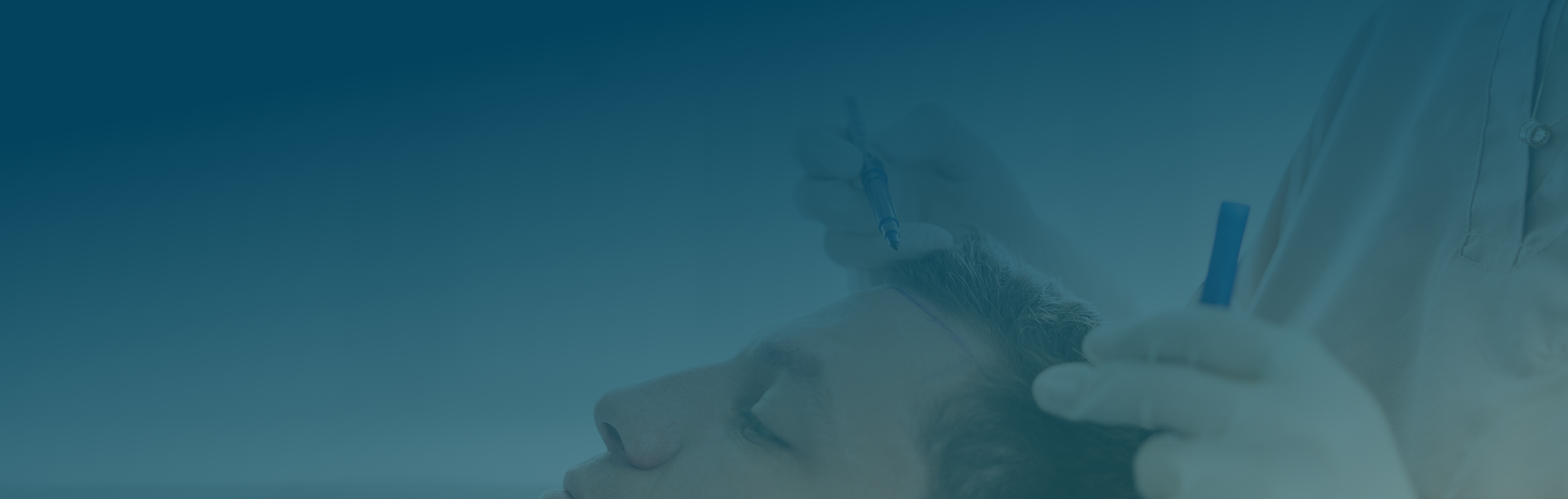 Hair Transplant FAQ's