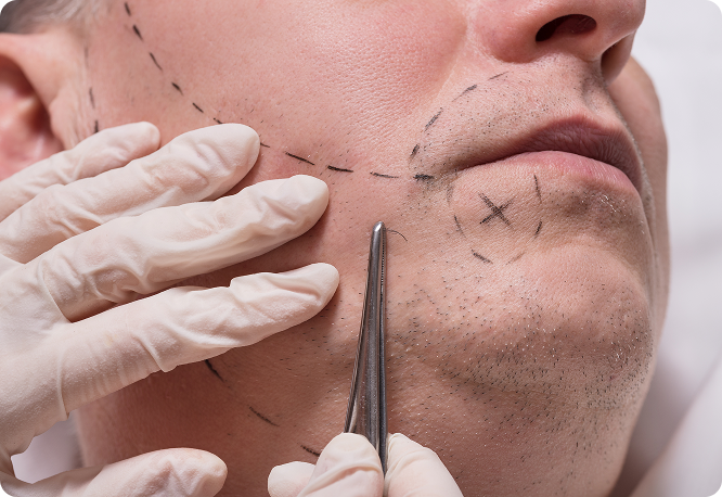 Surgeon marking the beard area before a facial hair transplant procedure