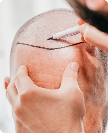 Surgeon marking the donor area before an FUT hair transplant procedure